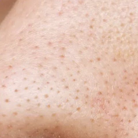 Close-up of blackheads on the nose