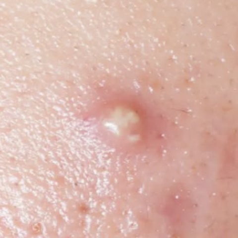 Close-up of a swollen pimple