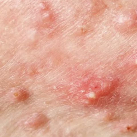 Close-up of pimples and breakouts on the skin